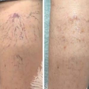 Before and after of Aerolase laser technology for  spider veins