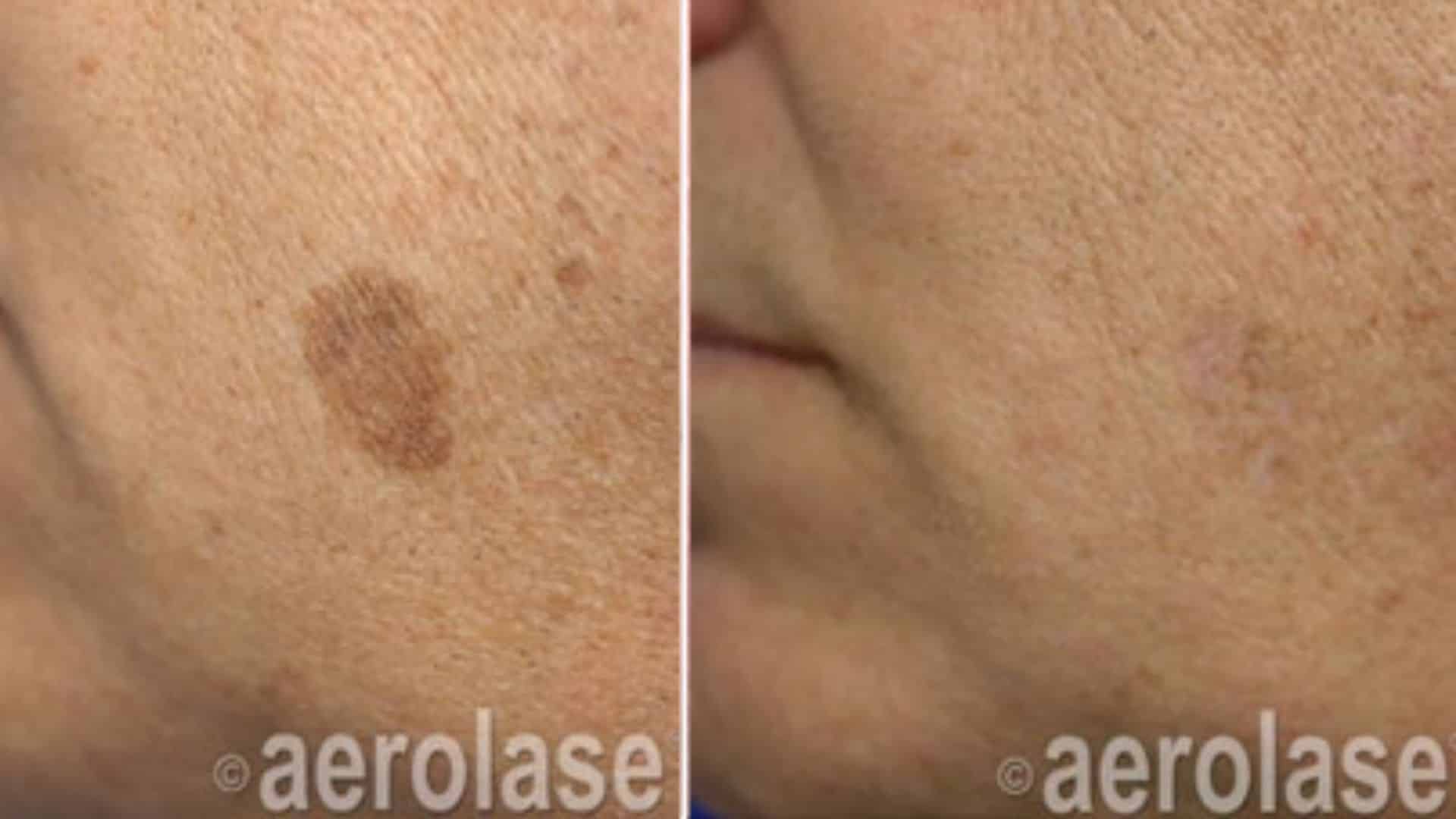 before and after pigmentation treatment