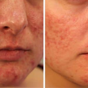 before and after of Aerolase laser technology for acne