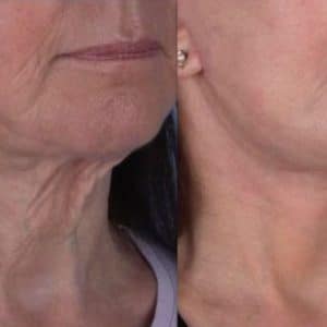 Before and after of Aerolase laser technology for skin tightening