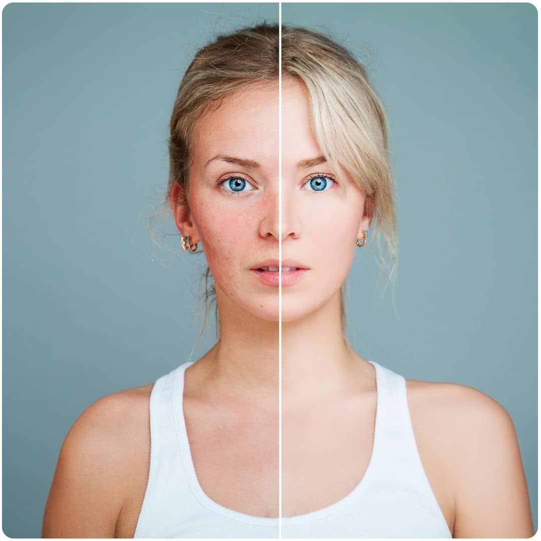 a before and after image of a woman with a skin condition