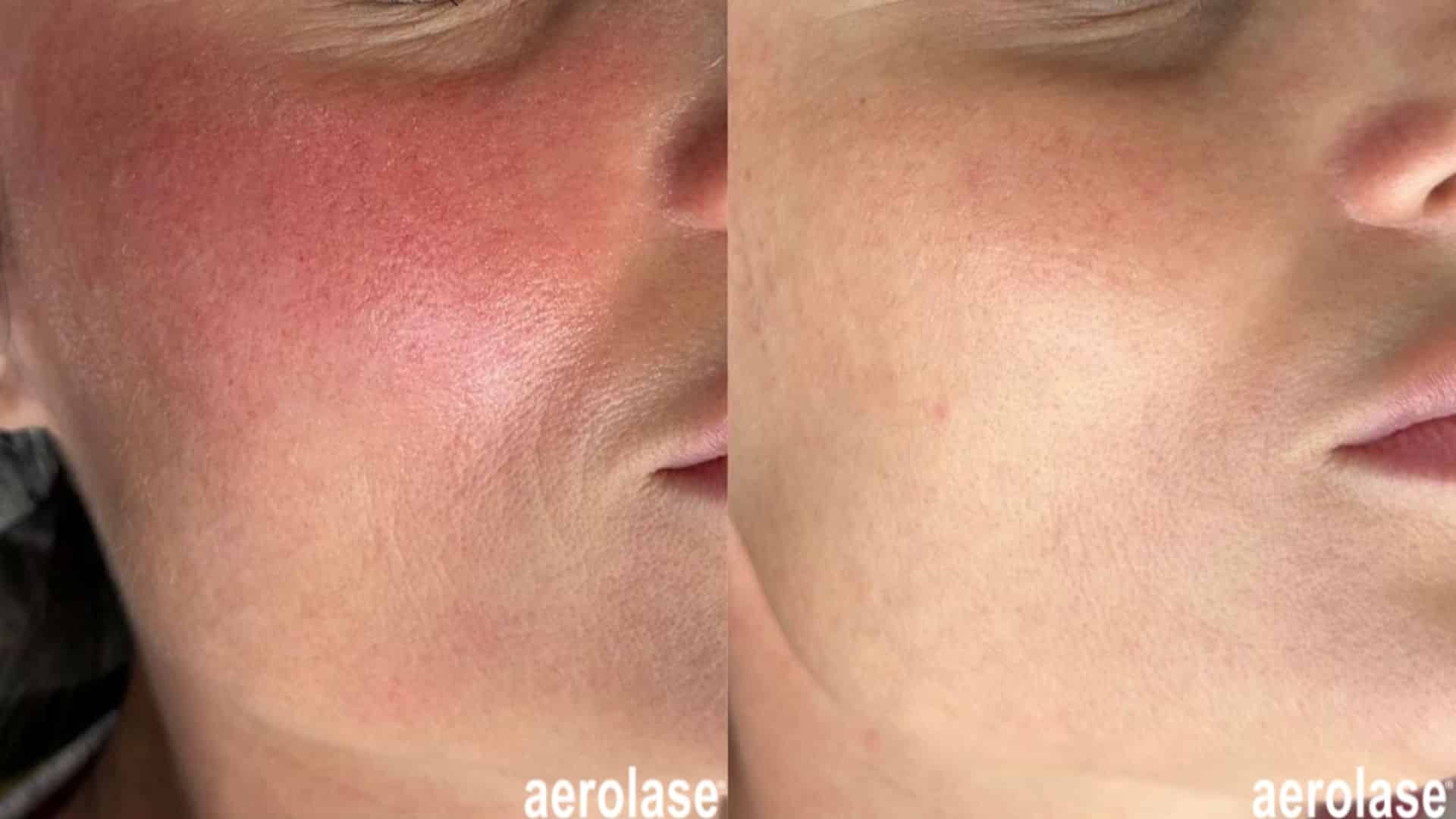 before and after Rosacea treatment