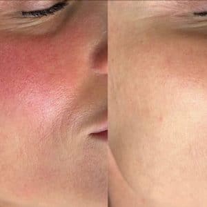 Before and after of Aerolase laser technology for rosacea