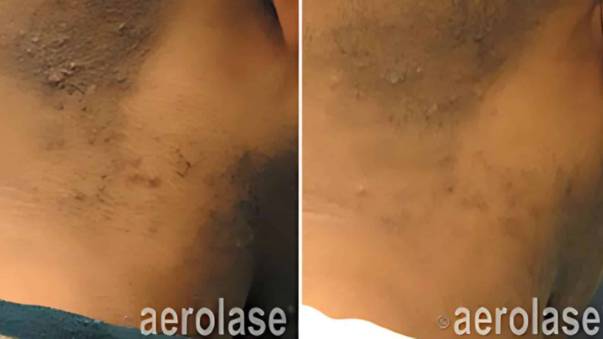 before and after PFB treatment